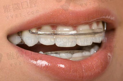 直接法树脂美学牙体修复3（前牙美容树脂修复案例）(图1)